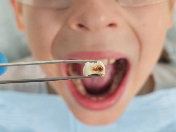 Best Emergency Root Canal Treatment in Guttenberg, IA